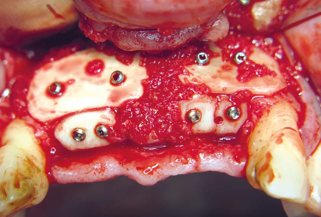 Three-dimensional augmentation with maxgraft® cortico - M.Sc. E. Kapogianni