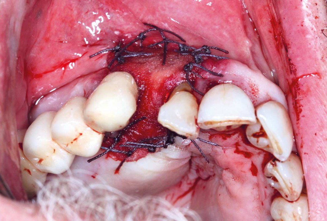 Regeneration with mucoderm® after fibroma resection