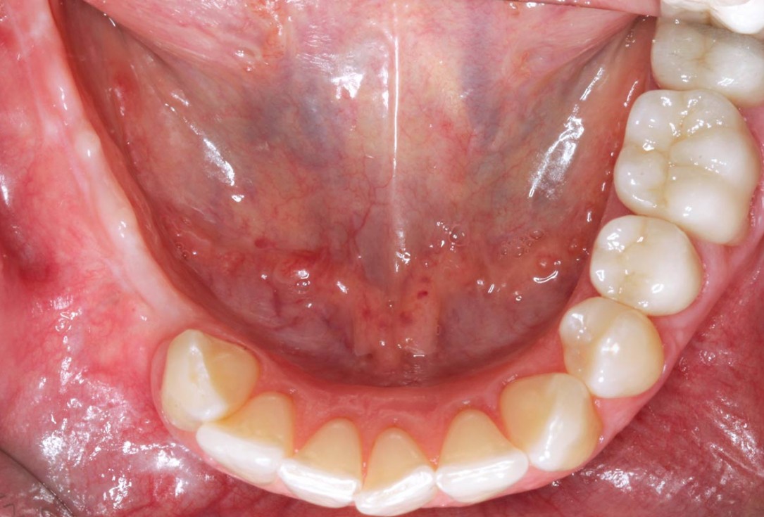 Horizontal ridge augmentation in the mandible with maxgraft® bonebuilder - Dr. O. Yüksel