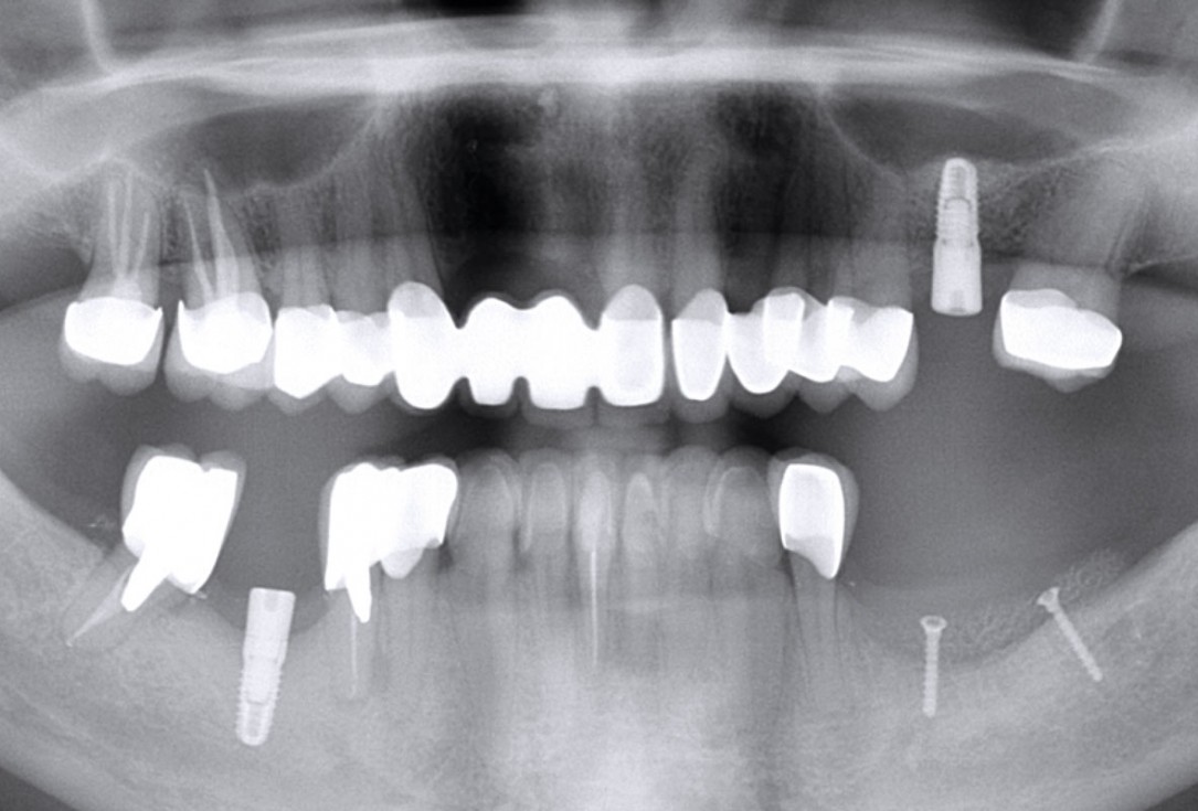 Ridge augmentation in the mandible with maxgraft® bonebuilder in a free-end situation - Dr. Dr. Dr. O. Blume