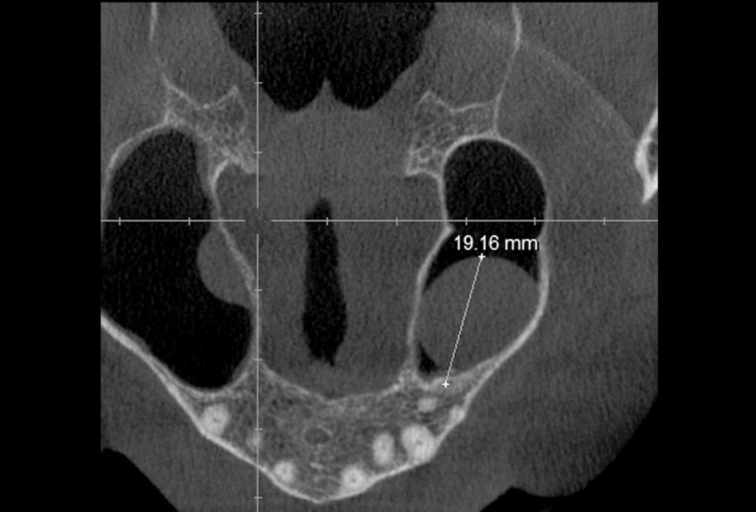 03/35 Maxillary sinus cyst removal using the Crocodile Technique and subsequent lateral sinus lift with cerabone®, maxgraft® and Jason® membrane - Dres. C. Scognamiglio and A. Perucchi