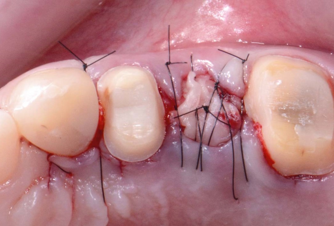 Full bone regeneration in extraction socket augmented with maxgraft® and Jason® membrane – Dr. C. Landsberg