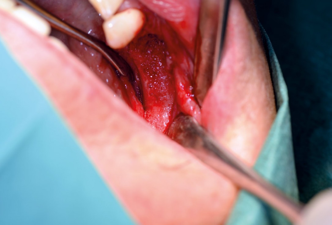 botiss maxgraft® bonebuilder for mandibular reconstruction - Clinical case