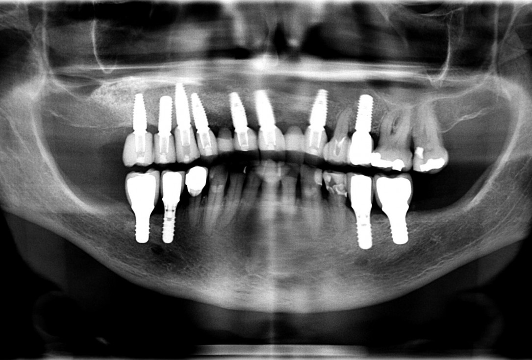 Augmentation of an atrophic ridge - Dr. R. Morger