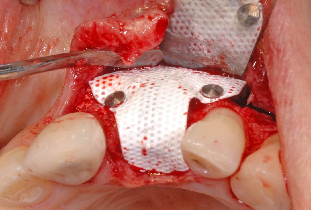 GBR together with soft tissue augmentation with mucoderm® and maxresorb® - Scherg