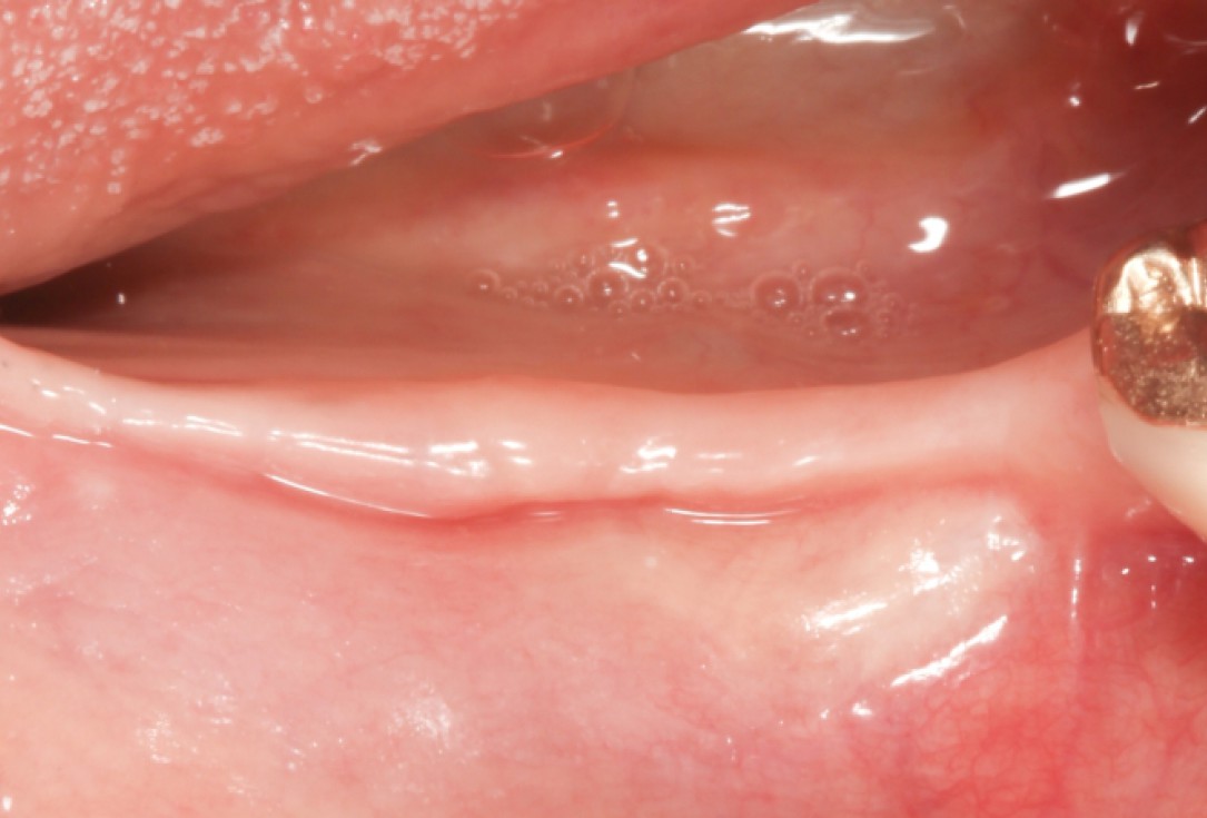 Ridge augmentation with maxgraft® bonebuilder - Dr. M. Jacotti