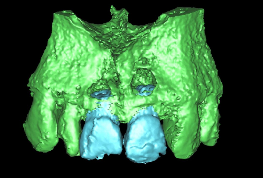 Ridge preservation with cerabone® Jason® membrane - Dr. D. Jelušić