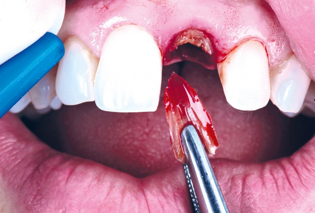 Excellent aesthetic result of buccal augmentation with mucoderm® and maxgraft® after immediate implant placement - 3-years follow-up - Dr. A. Puišys 