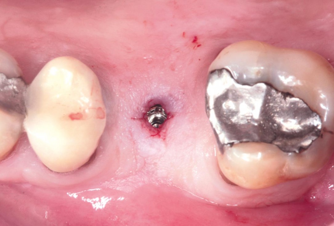 27/35 Maxillary sinus cyst removal using the Crocodile Technique and subsequent lateral sinus lift with cerabone®, maxgraft® and Jason® membrane - Dres. C. Scognamiglio and A. Perucchi