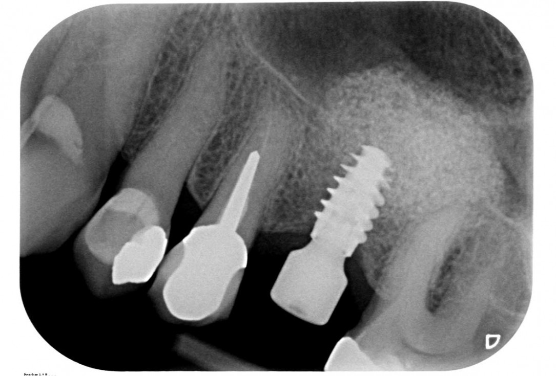 29/35 Maxillary sinus cyst removal using the Crocodile Technique and subsequent lateral sinus lift with cerabone®, maxgraft® and Jason® membrane - Dres. C. Scognamiglio and A. Perucchi