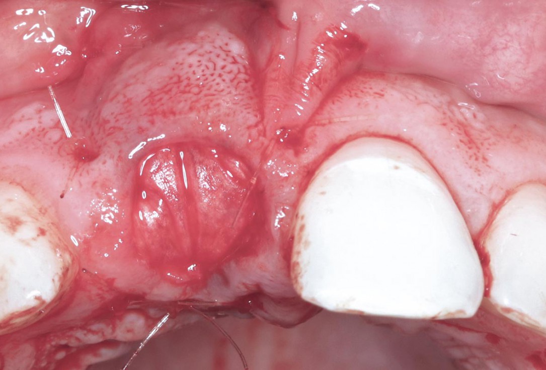 Type II socket defect grafted and repaired in a flapless way using Jason® membrane and maxgraft® cortico-cancellous - Dr. A. Jones