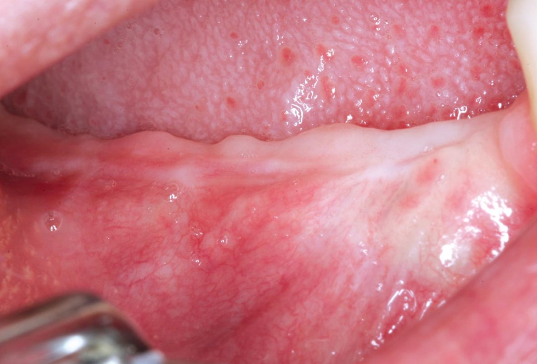 Horizontal ridge augmentation in the mandible with maxgraft® bonebuilder - Dr. O. Yüksel