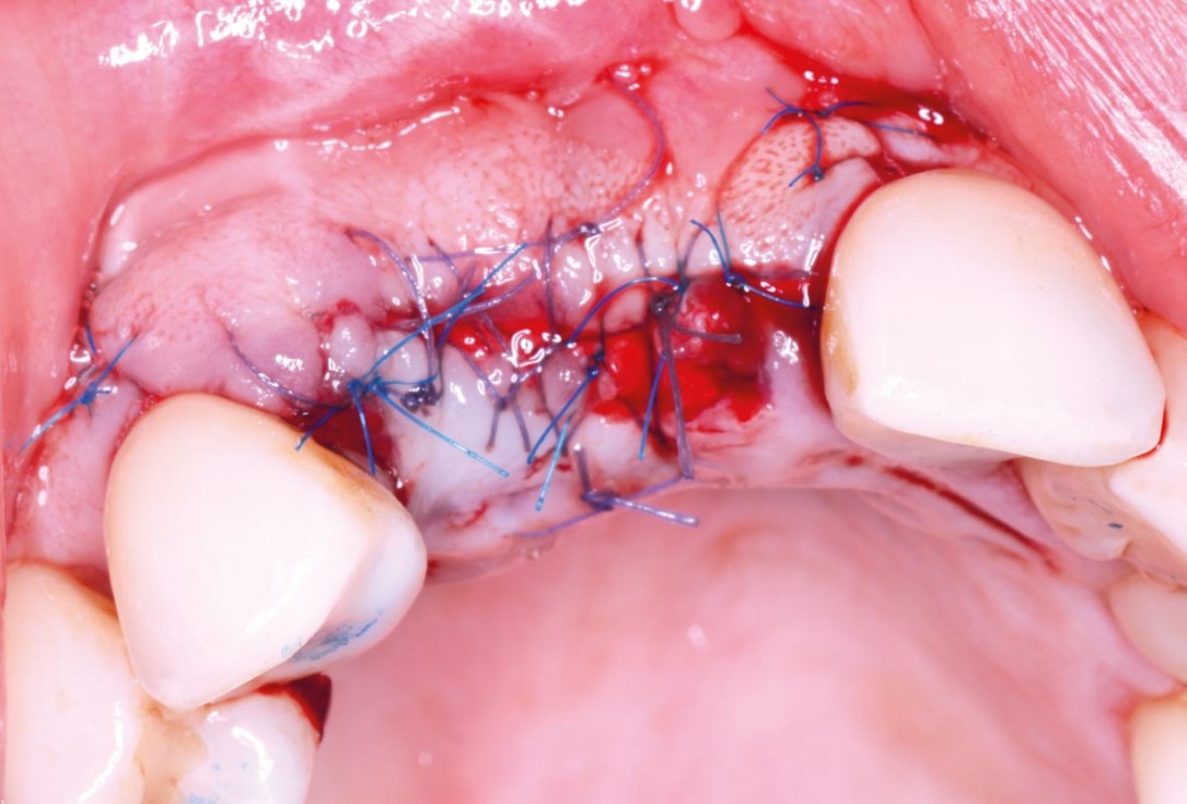 Maxillary bone reconstruction in the anterior area with cerabone and Jason membrane - Dr. P.-Y. Gegout & Prof. O. Huck