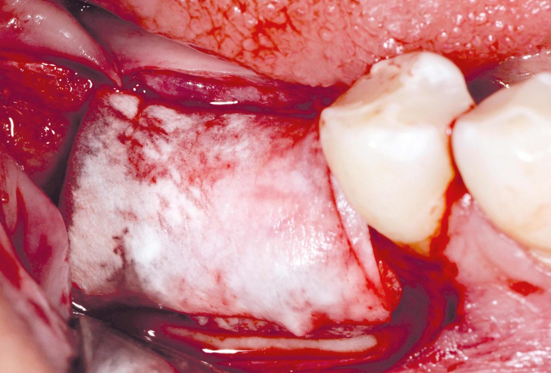 Ridge augmentation in the mandible with maxgraft® bonebuilder– Dr. R. Morger