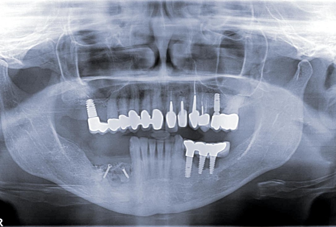 botiss maxgraft® bonebuilder for mandibular reconstruction - Clinical case