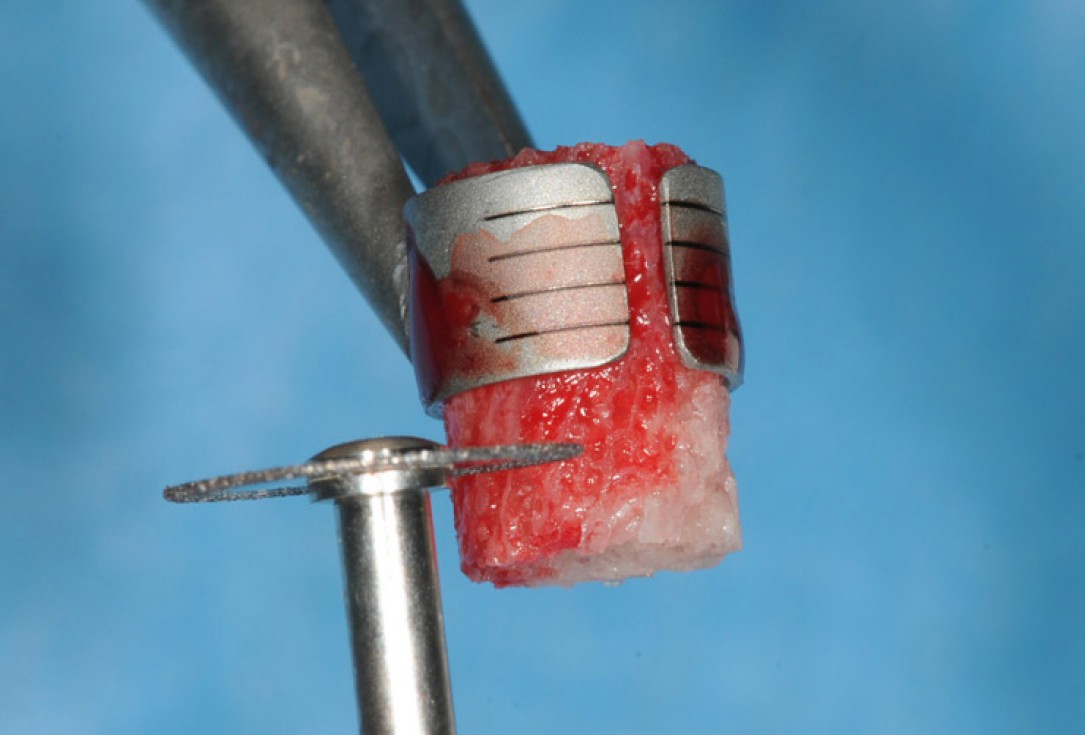 Restoration of buccal bone lamella in aesthetic zone with maxgraft® bonering - Dr. A. Patel