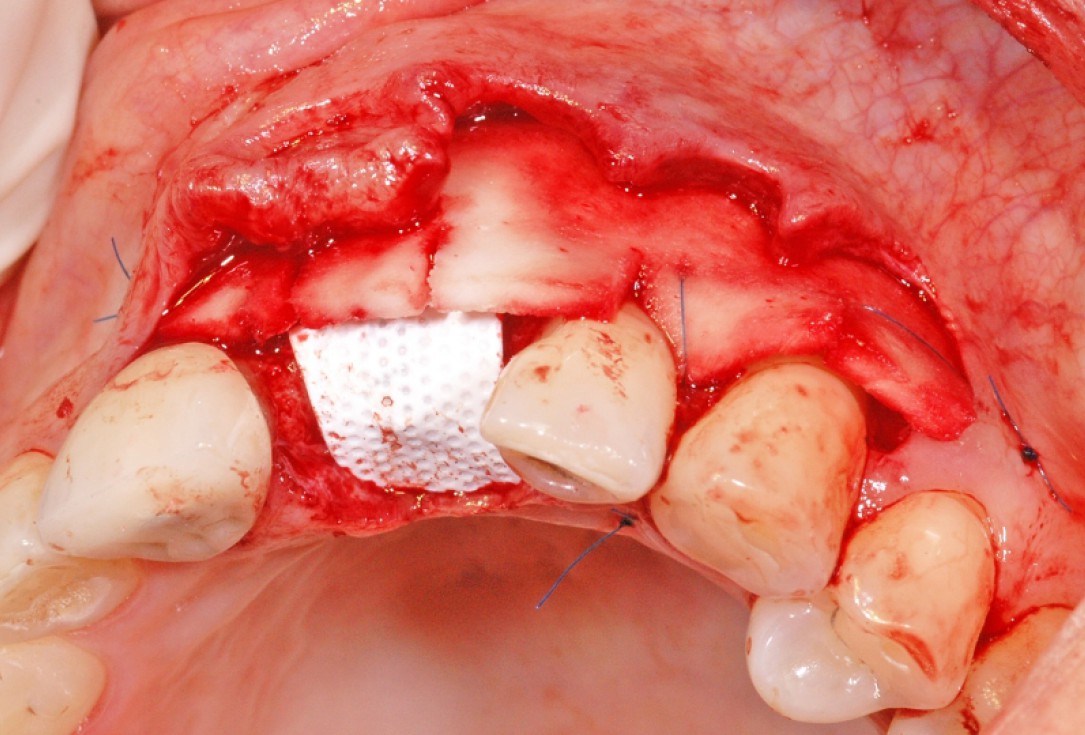 GBR together with soft tissue augmentation with mucoderm® and maxresorb® - Scherg