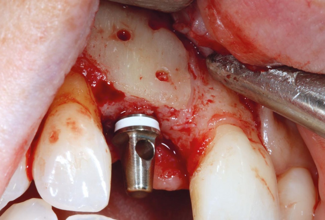 maxgraft® cortico at combined defect palatally and facially - Dr. K. Höckl