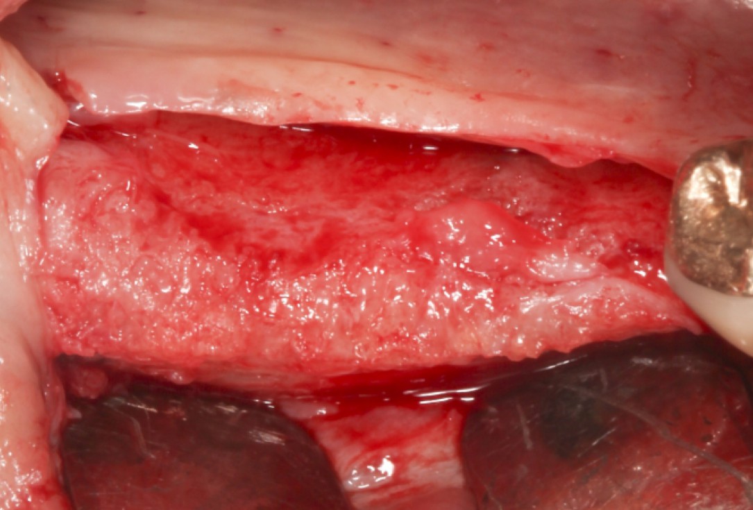 Ridge augmentation with maxgraft® bonebuilder - Dr. M. Jacotti