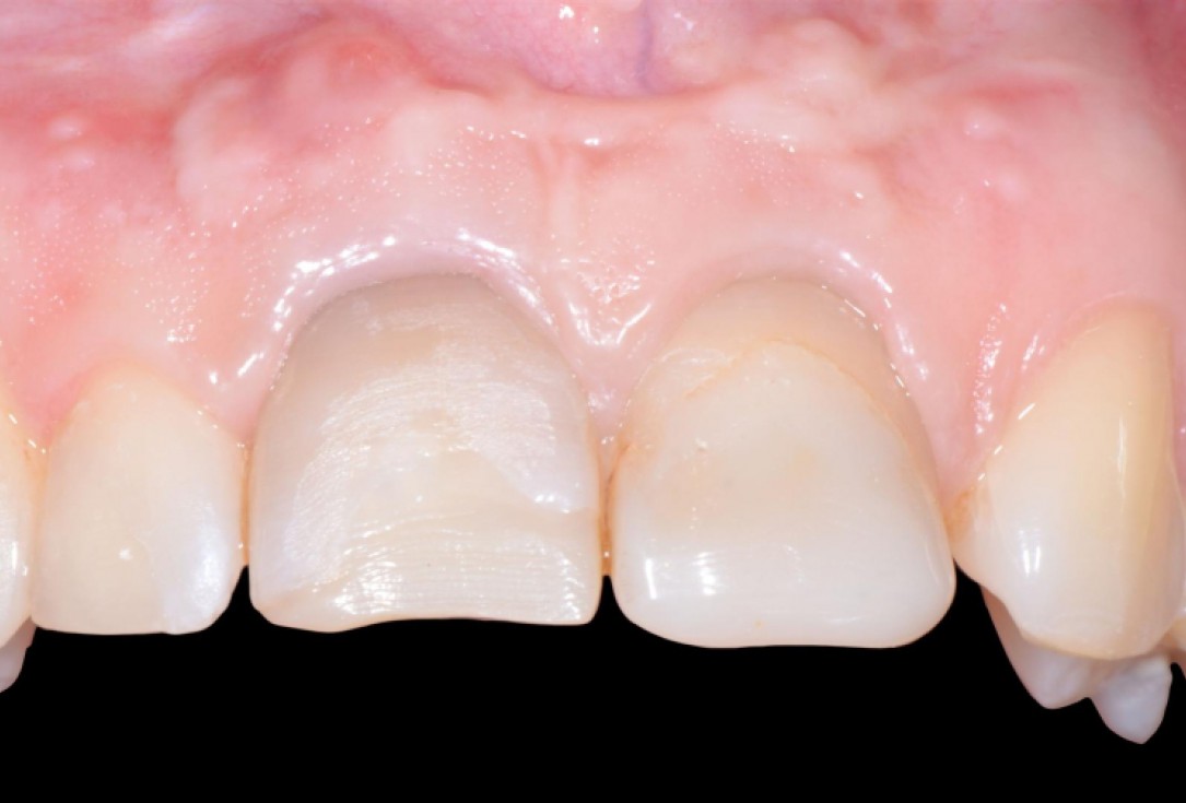 Ridge preservation with cerabone® Jason® membrane - Dr. D. Jelušić