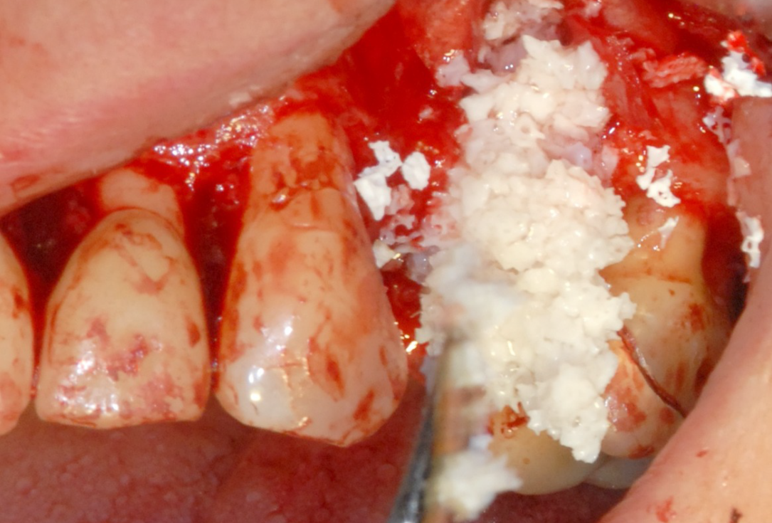 Ridge preservation with cerabone® and Jason® membrane - Dr. Derk Siebers