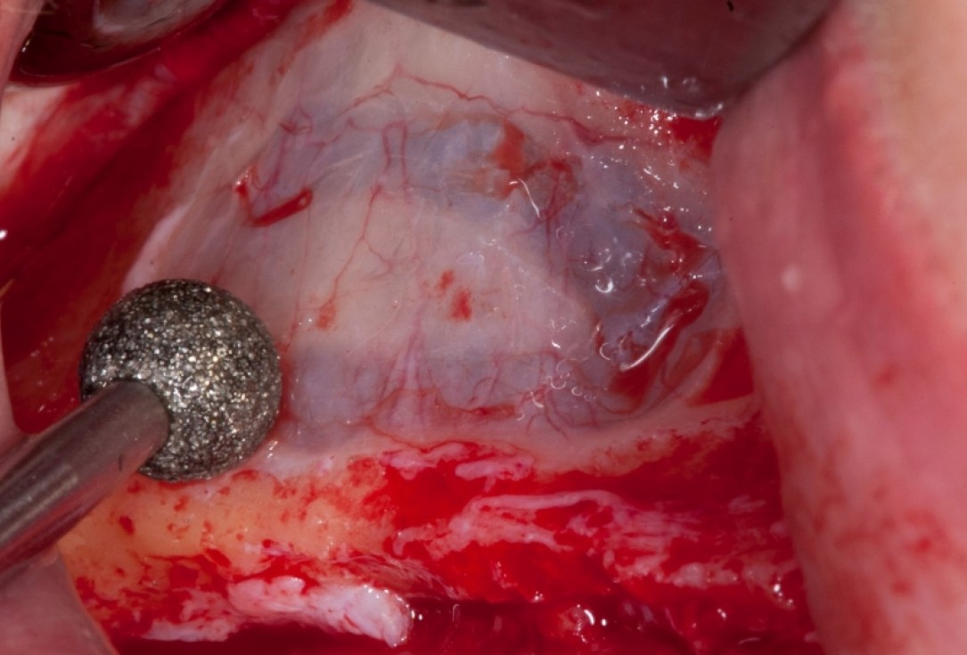 Vertical augmentation and sinus lift with maxgraft® bonering - Dr. O. Yüksel and Dr. B. Giesenhagen