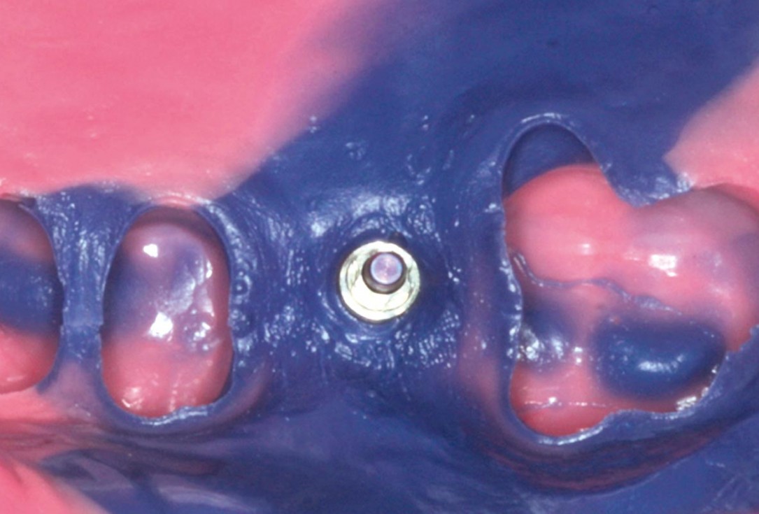 32/35 Maxillary sinus cyst removal using the Crocodile Technique and subsequent lateral sinus lift with cerabone®, maxgraft® and Jason® membrane - Dres. C. Scognamiglio and A. Perucchi