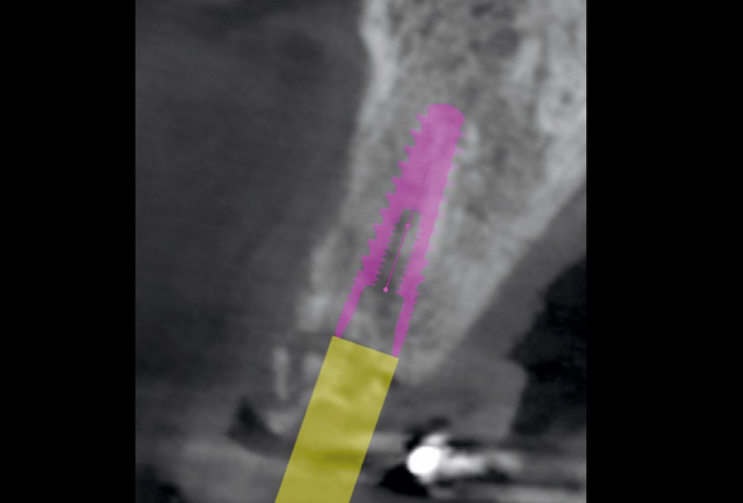Type II socket defect grafted and repaired in a flapless way using Jason® membrane and maxgraft® cortico-cancellous - Dr. A. Jones