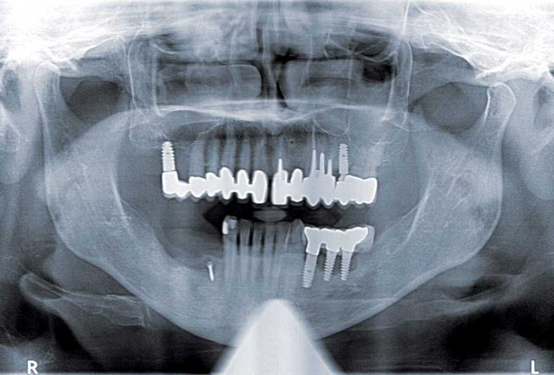 botiss maxgraft® bonebuilder for mandibular reconstruction - Clinical case