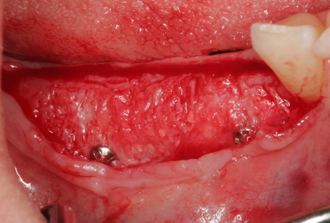 Horizontal ridge augmentation in the mandible with maxgraft® bonebuilder - Dr. O. Yüksel