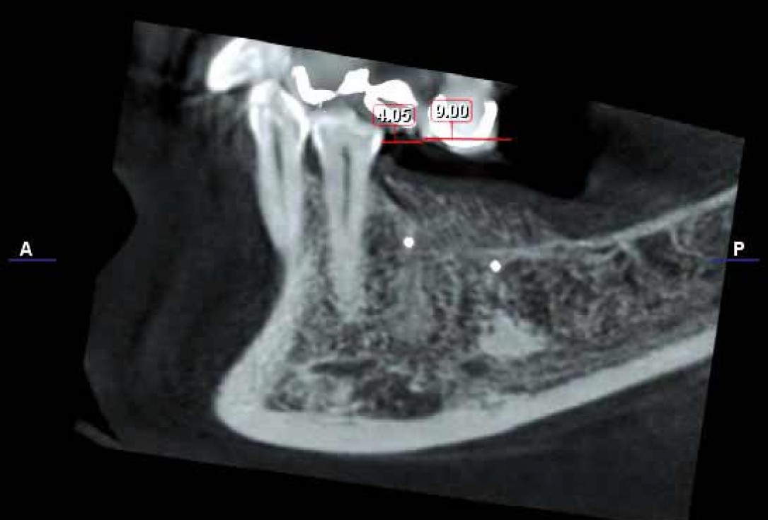 Ridge augmentation in the mandible with maxgraft® bonebuilder– Dr. R. Morger