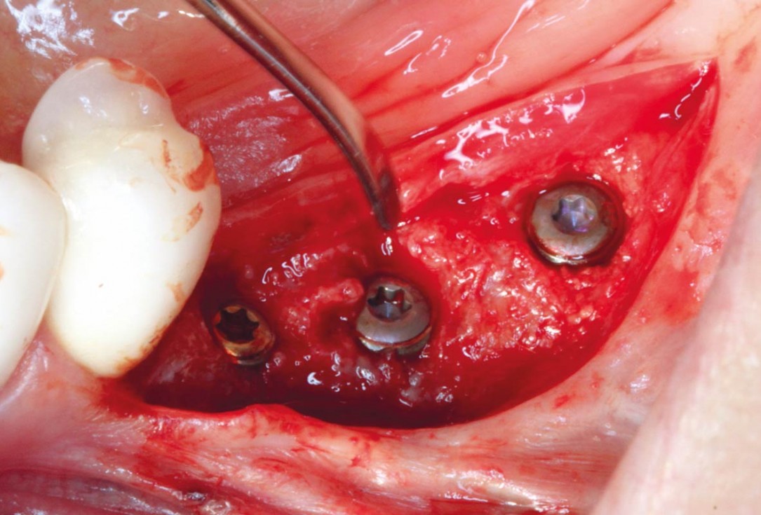 Ridge augmentation in the mandible with maxgraft® bonebuilder in a free-end situation - Dr. Dr. Dr. O. Blume