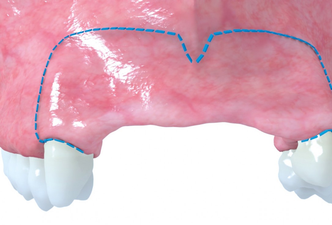 botiss maxgraft® bonebuilder aesthetic reconstruction - Clinical case