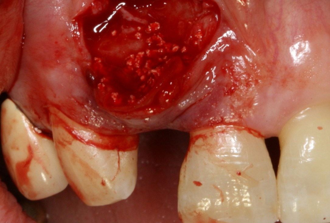 09/20 GBR with maxresorb® and Jason® membrane - Prof. Dr. Dr. D. Rothamel