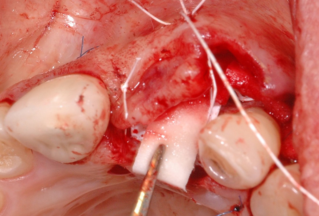 GBR together with soft tissue augmentation with mucoderm® and maxresorb® - Scherg