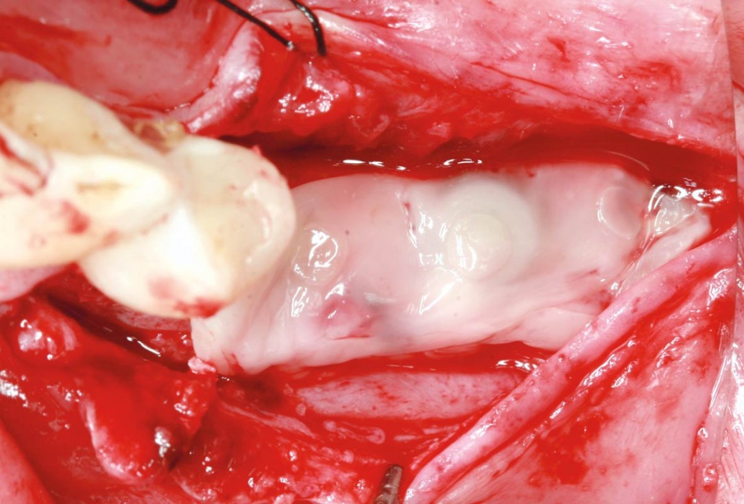maxgraft® cortico at free-end situation in the mandible - J. Kielhorn
