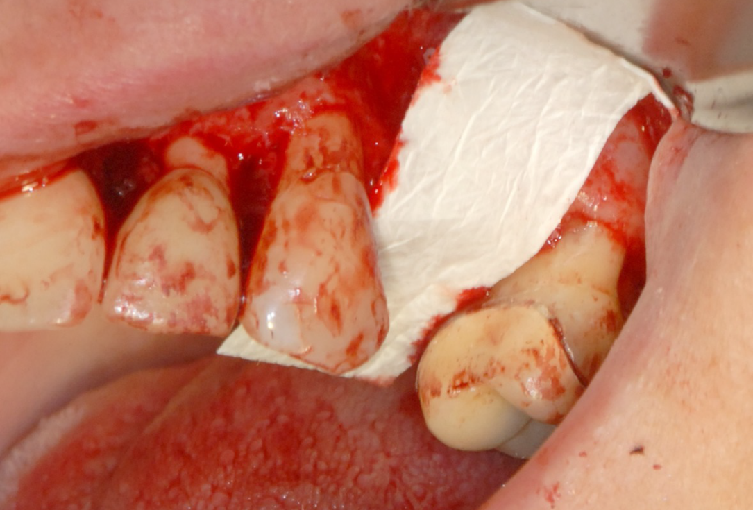 Ridge preservation with cerabone® and Jason® membrane - Dr. Derk Siebers