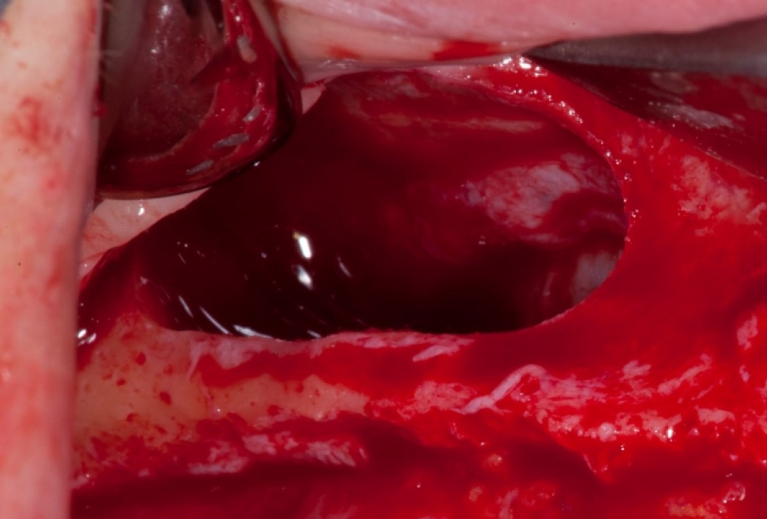 Vertical augmentation and sinus lift with maxgraft® bonering - Dr. O. Yüksel and Dr. B. Giesenhagen