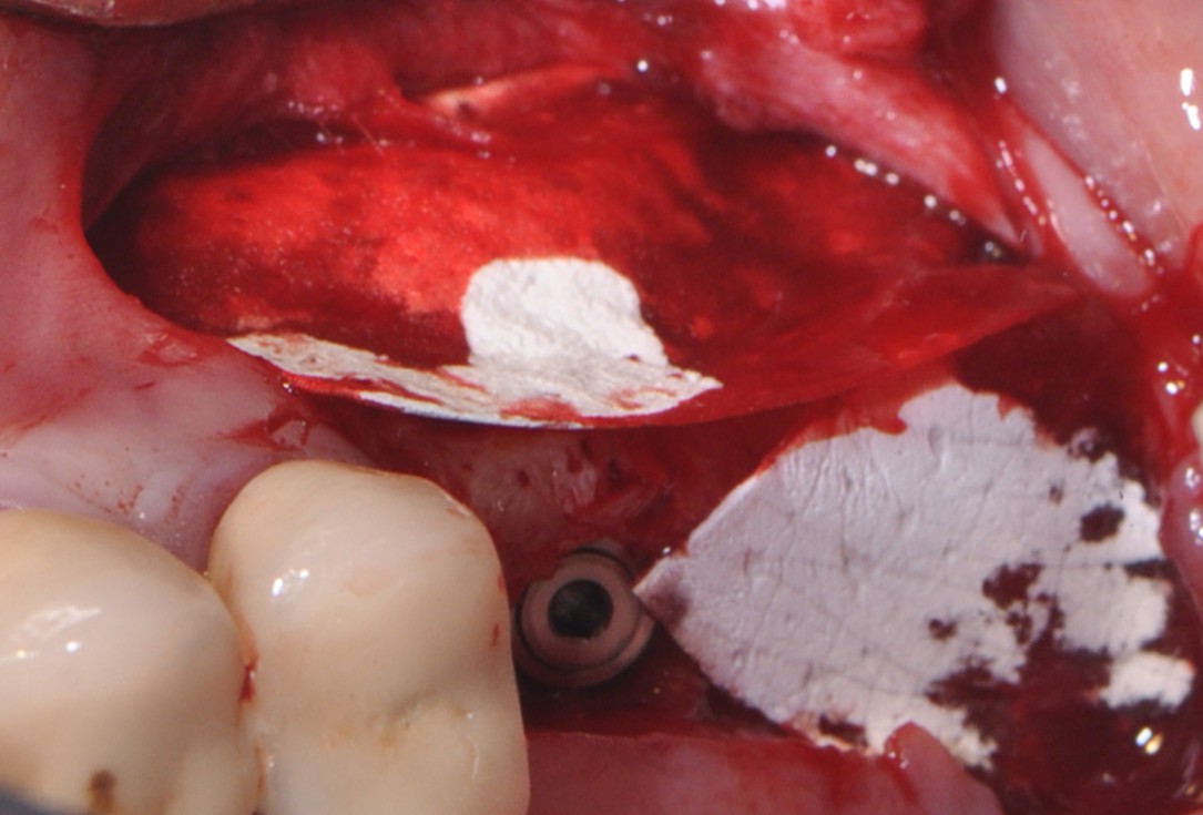 Sinus lift with simultaneous implantation with cerabone® and collprotect® membrane - clinical case Dr. Victor Kalenchuk