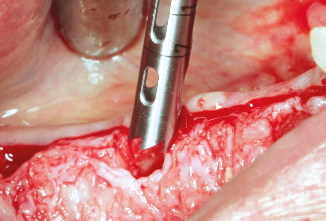 Horizontal ridge augmentation in the mandible with maxgraft® bonebuilder - Dr. O. Yüksel