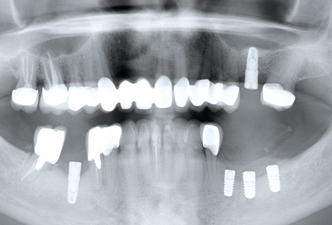 Ridge augmentation in the mandible with maxgraft® bonebuilder in a free-end situation - Dr. Dr. Dr. O. Blume