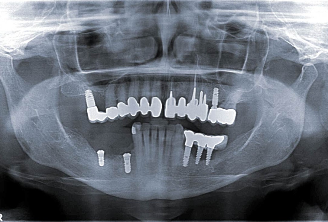 botiss maxgraft® bonebuilder for mandibular reconstruction - Clinical case