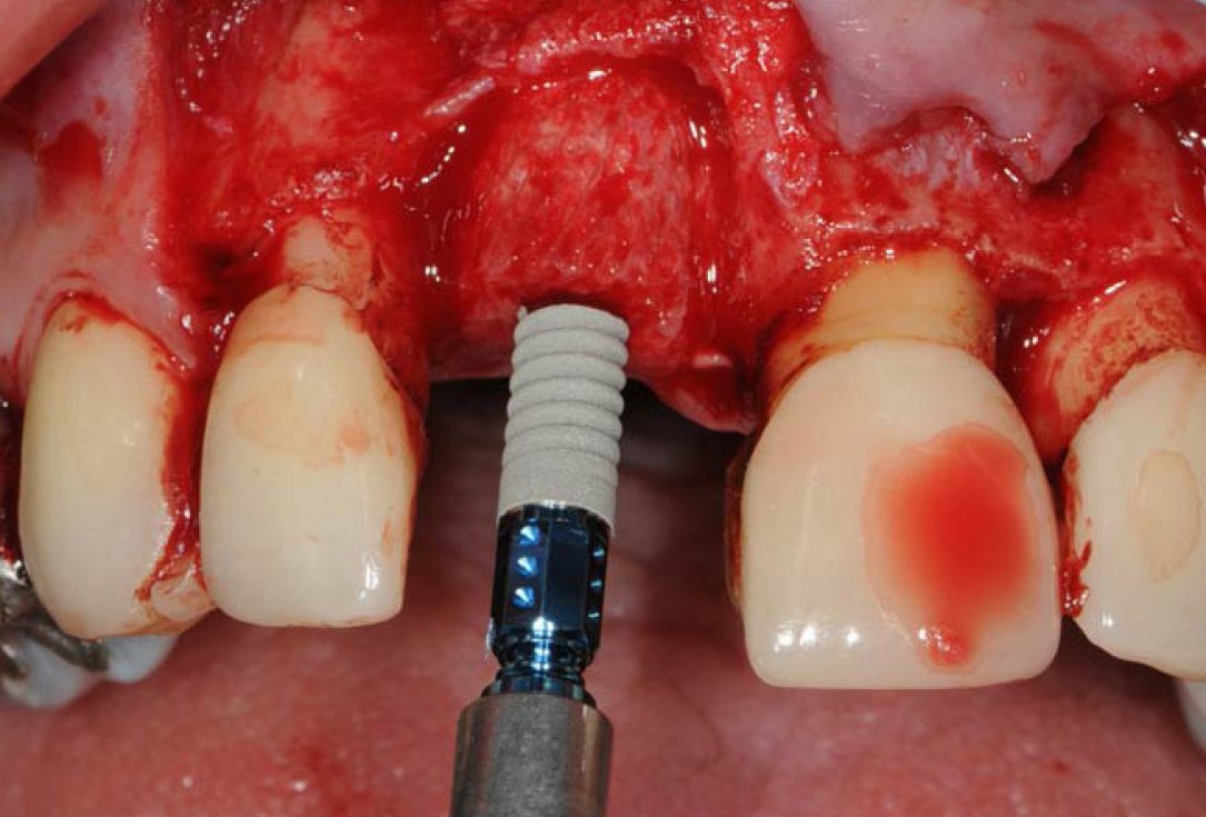 Restoration of buccal bone lamella in aesthetic zone with maxgraft® bonering - Dr. A. Patel