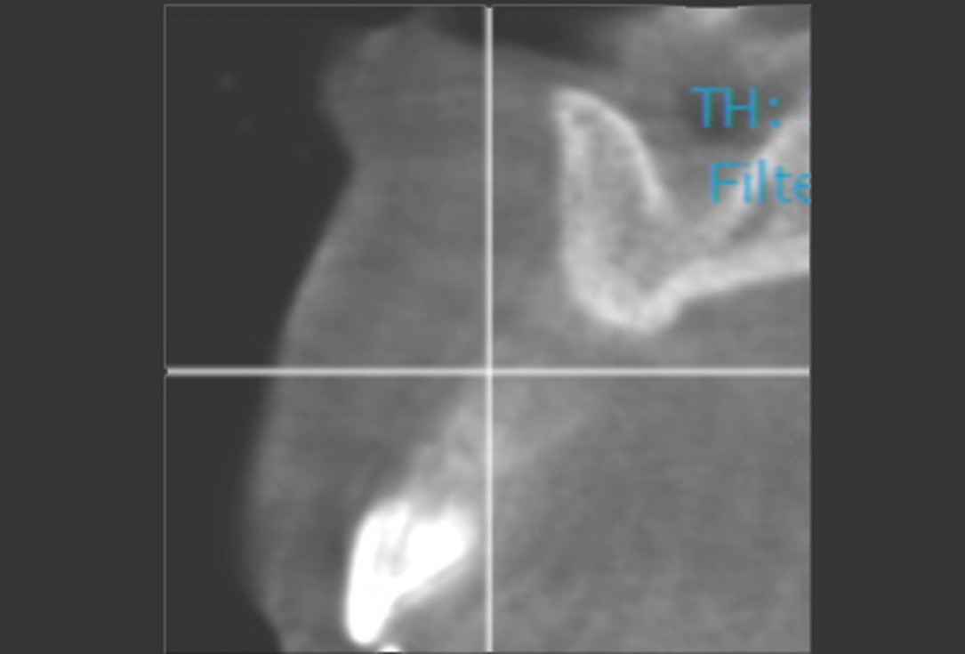 maxgraft® cortico at combined defect palatally and facially - Dr. K. Höckl