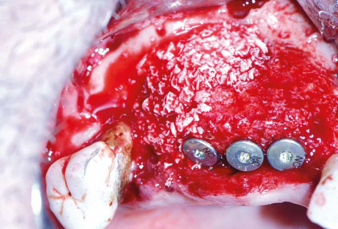 Ridge augmentation with maxgraft® bonebuilder and sinus floor elevation – Dr. K.P. Schiechl