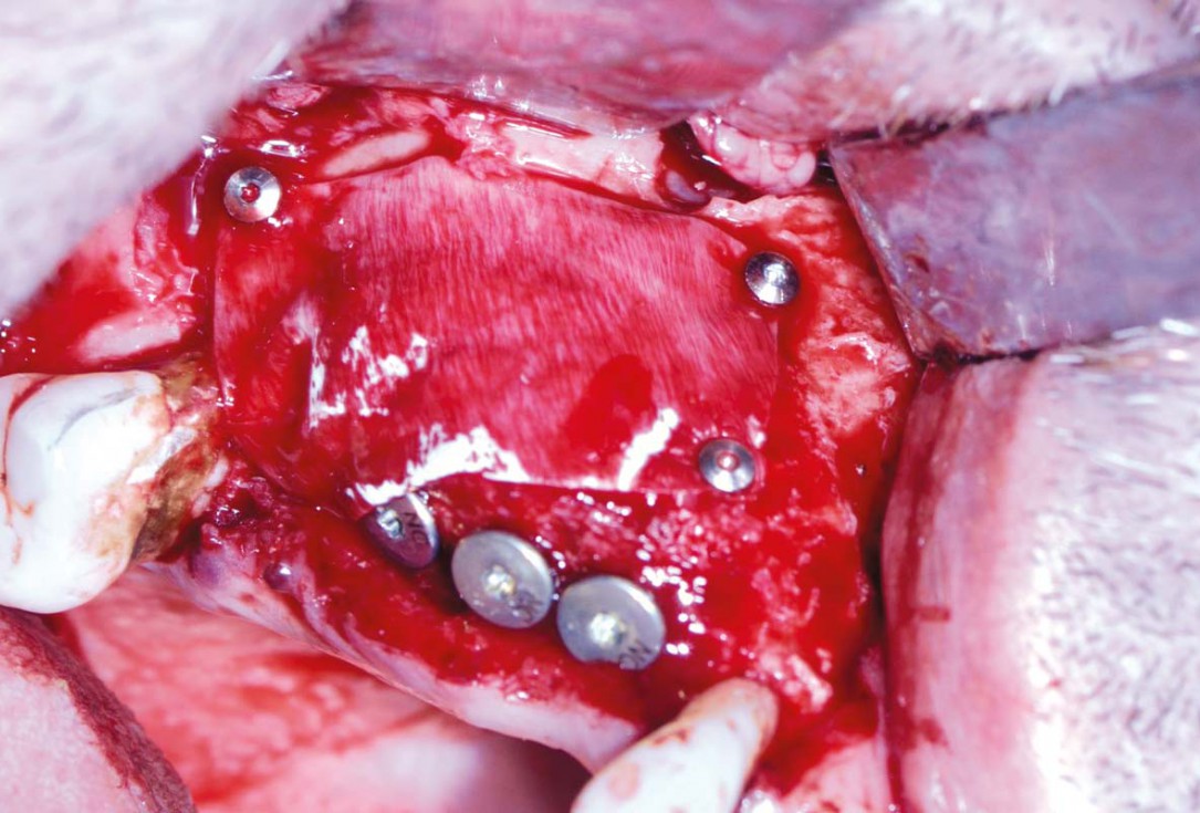 Ridge augmentation with maxgraft® bonebuilder and sinus floor elevation – Dr. K.P. Schiechl