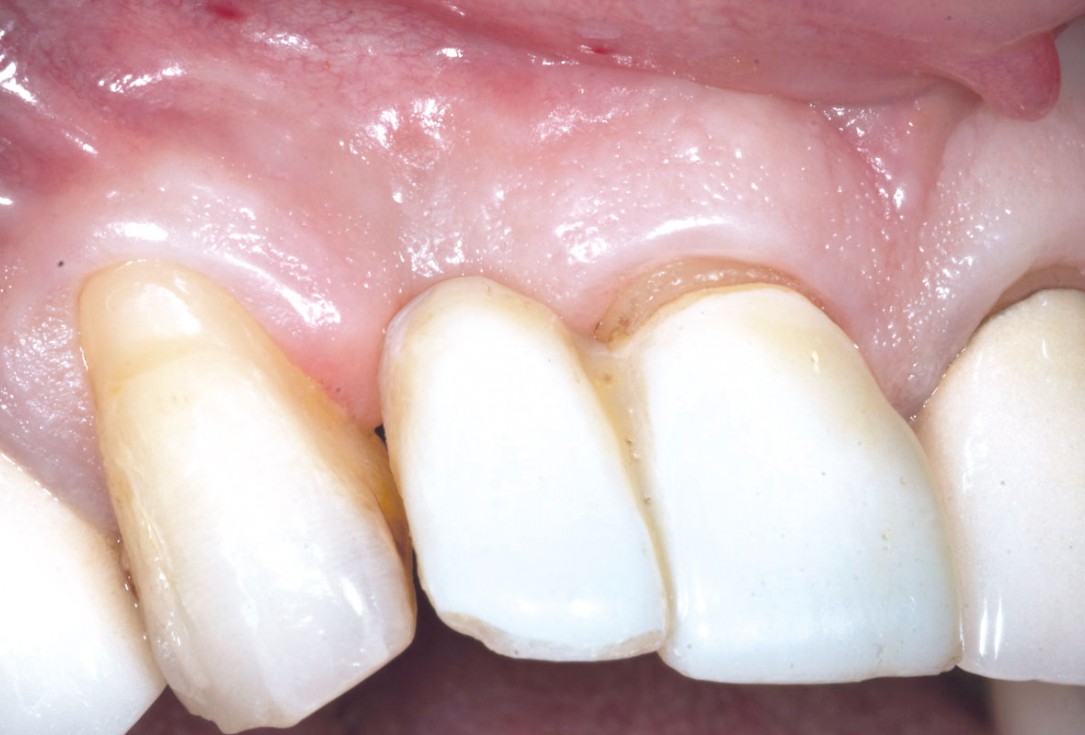 Bone augementation with maxresorb® - Dr. R. Cutts