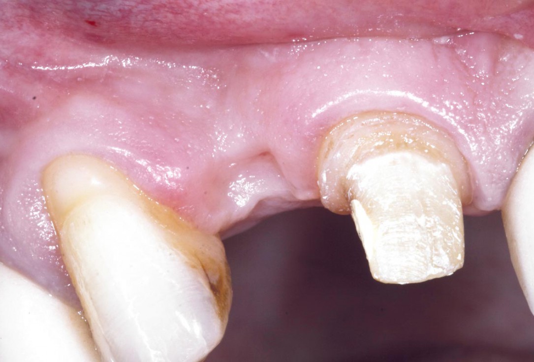 Bone augementation with maxresorb® - Dr. R. Cutts