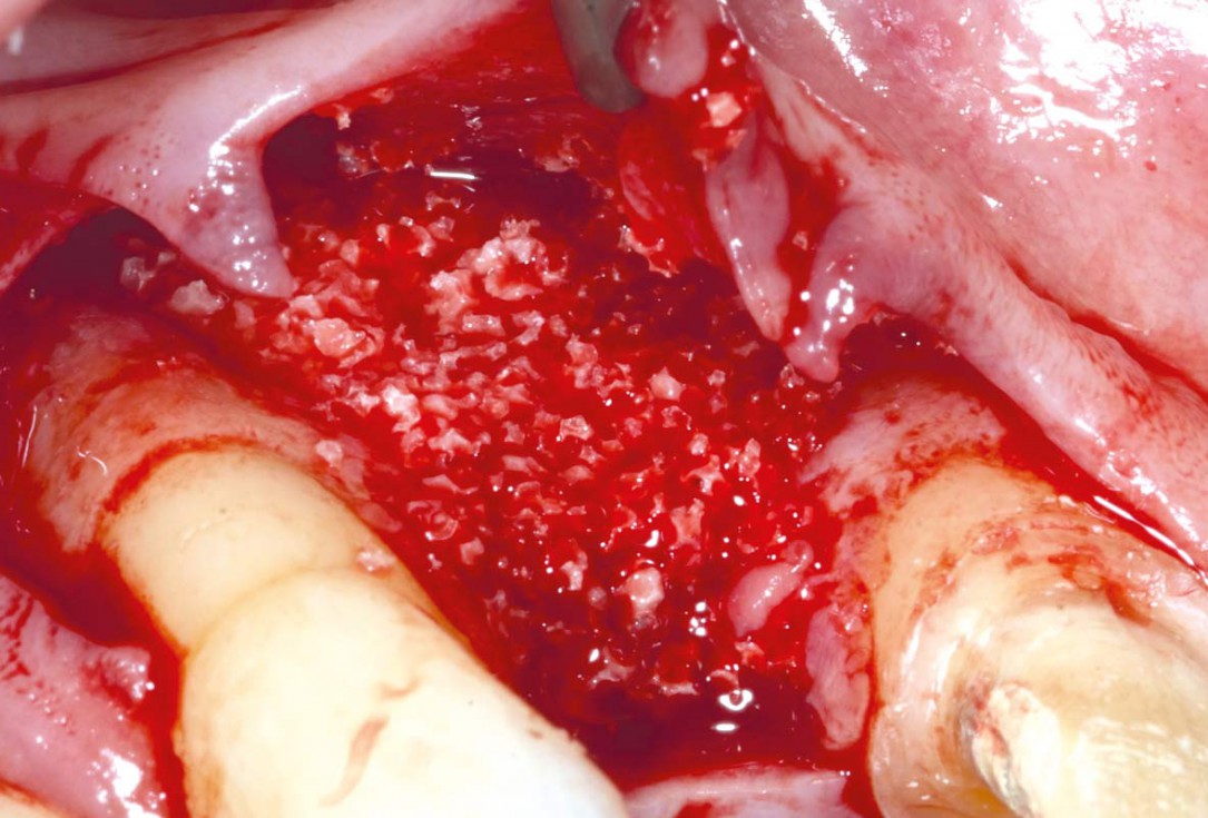 Bone augementation with maxresorb® - Dr. R. Cutts