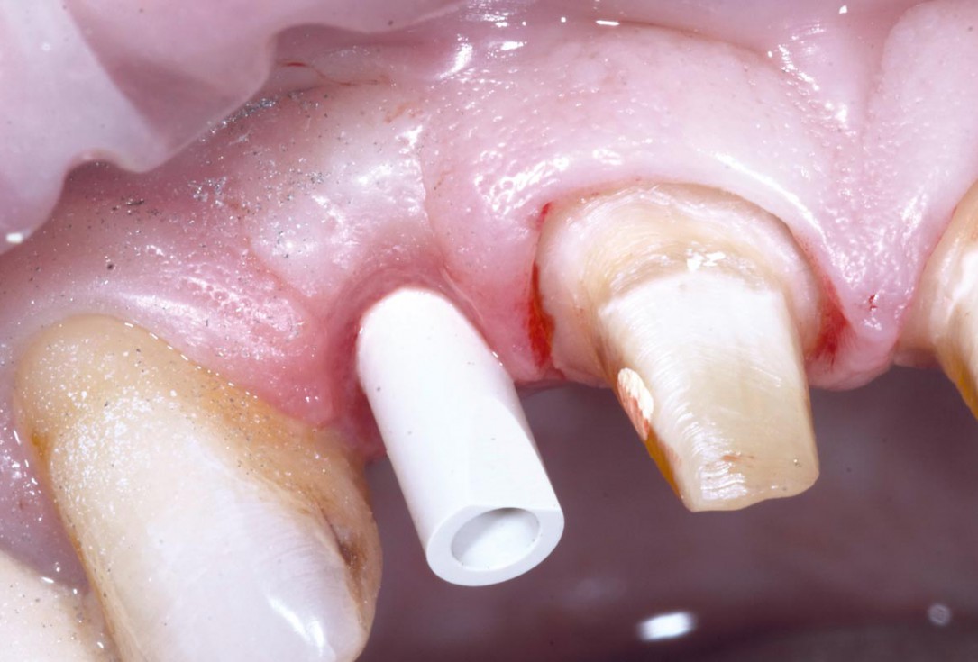 Bone augementation with maxresorb® - Dr. R. Cutts